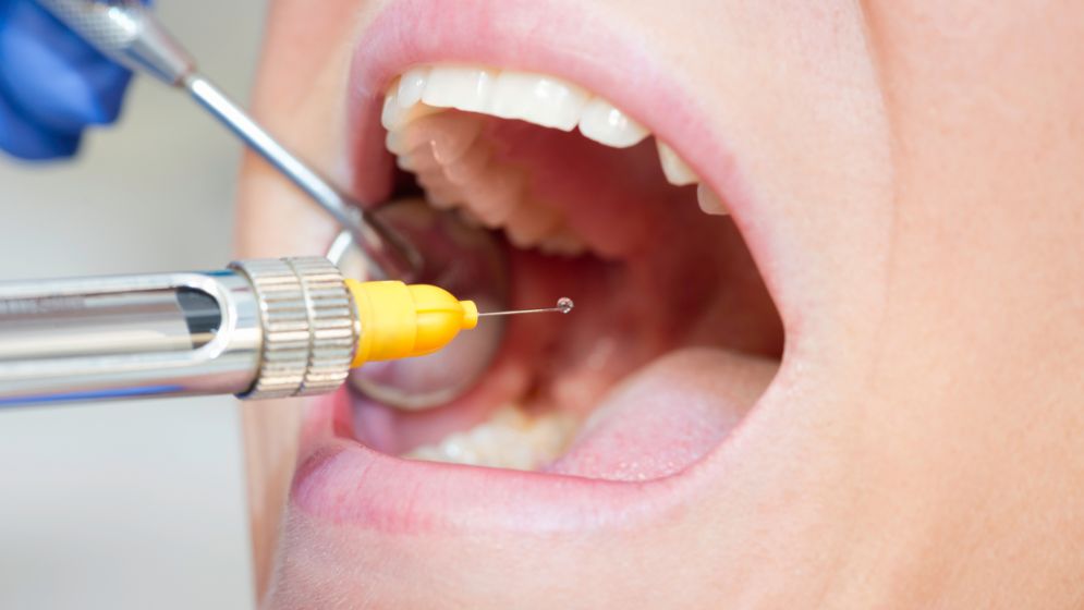 Bước 5 của quy trình bọc răng sứ tại Nha khoa Tracy