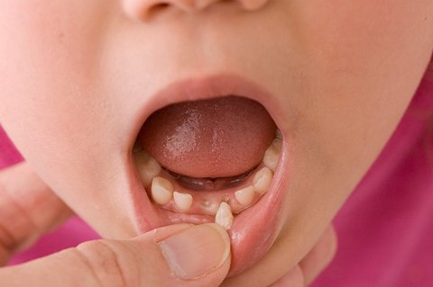 Dịch vụ nhổ răng sữa cho trẻ tại Nha khoa Tracy