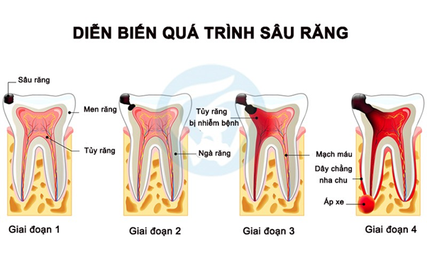 Minh họa diễn biến quá trình sâu răng