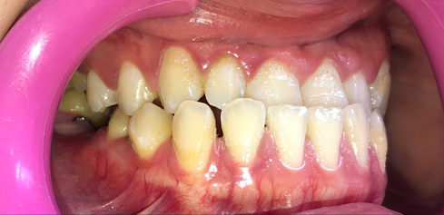 Hình ảnh tình trạng răng của khách hàng Cẩm Tú khi đến thăm khám tại Nha Khoa Tracy