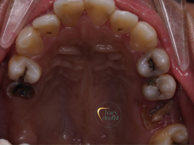 Hình ảnh về tình trạng răng của khách hàng Thu An khi đến thăm khám tại Nha Khoa Tracy