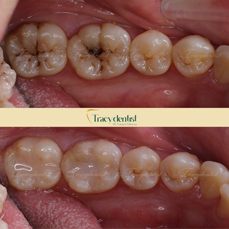 Hình ảnh răng của khách hàng trước và sau khi trám răng tại Nha Khoa Tracy 