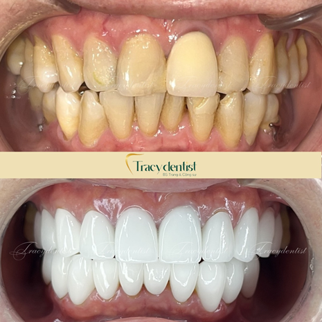 Hình ảnh trước và sau khi làm răng sứ
