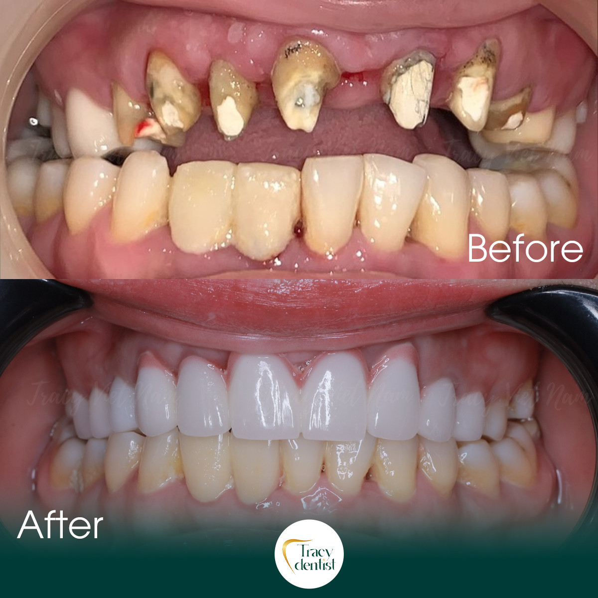 Răng được mài trước khi gắn răng sứ tại Tracy Việt Nam 
