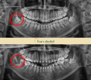 Hình ảnh x quang của khách hàng nhổ răng khi đến nha khoa Tracy