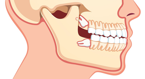 Minh họa răng khôn mọc lệch cả 2 hàm