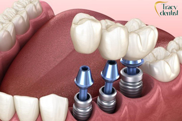 Minh họa trồng răng implant