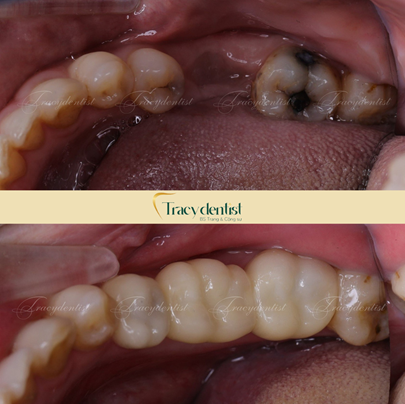 Hình ảnh trước và sau khi trồng răng implant