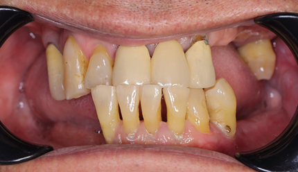 Tình trạng răng của khách trước khi cấy implant
