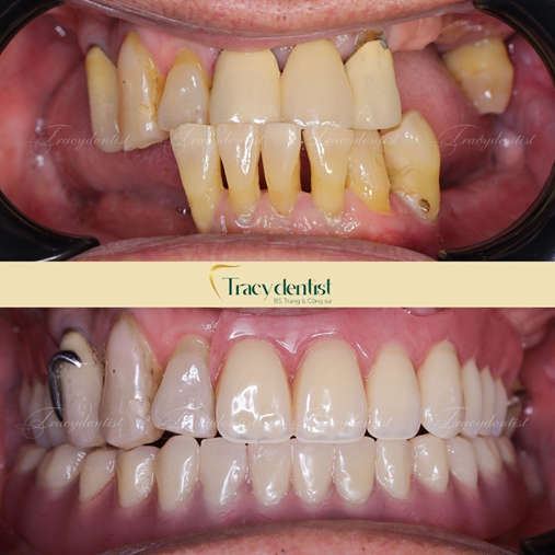 Trước và sau khi cấy implant cho khách hàng
