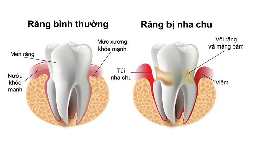 Răng bình thường và răng bị nha chu