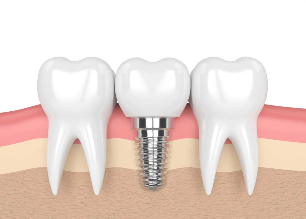 Răng giả tháo lắp trên implant