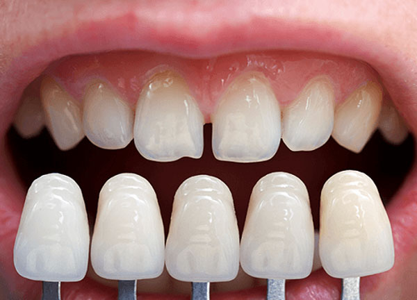 Chăm sóc răng miệng sau khi dán sứ Veneer