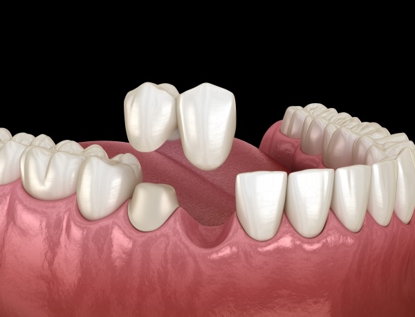  Tình trạng mất răng thường xảy ra ở người trẻ 