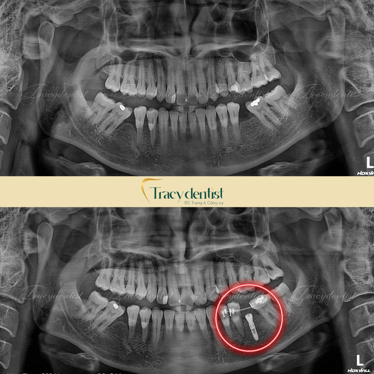 Hãy chụp CT cẩn thận trước khi trồng răng implant