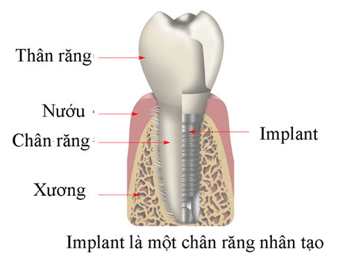 Minh họa diễn biến quá trình sâu răng
